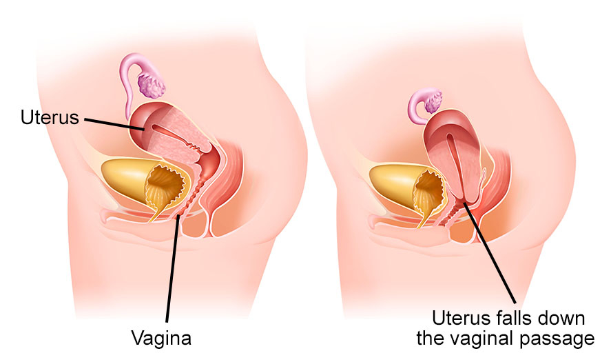 Pelvic Organ Prolapse